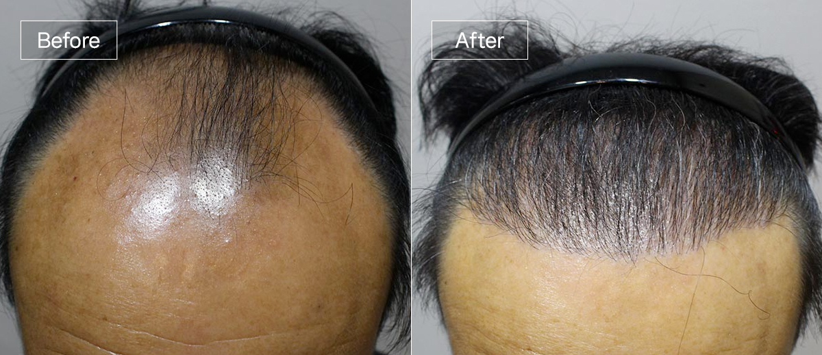 /filedata/md_board/20260102161417_YiE89dmz_sub1_slide2.jpg 전후사진