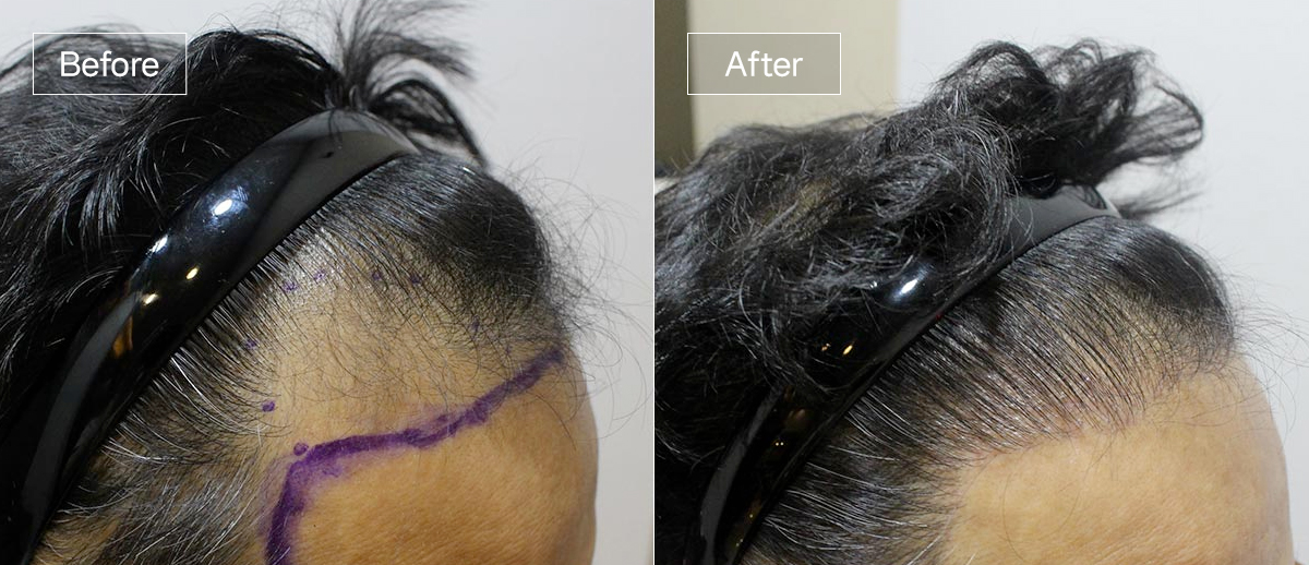 /filedata/md_board/20260102161424_SbrdqNc0_sub1_slide3.jpg 전후사진