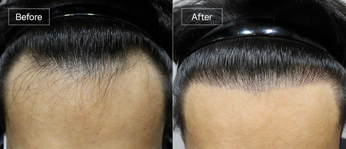 /filedata/md_board/20260102161433_i3hWYZrM_sub1_slide4.jpg 전후사진