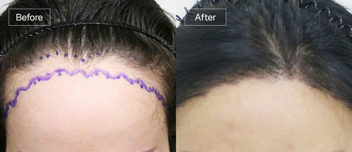 /filedata/md_board/20260102162011_rpDqY0C7_sub3_slide1.jpg 전후사진