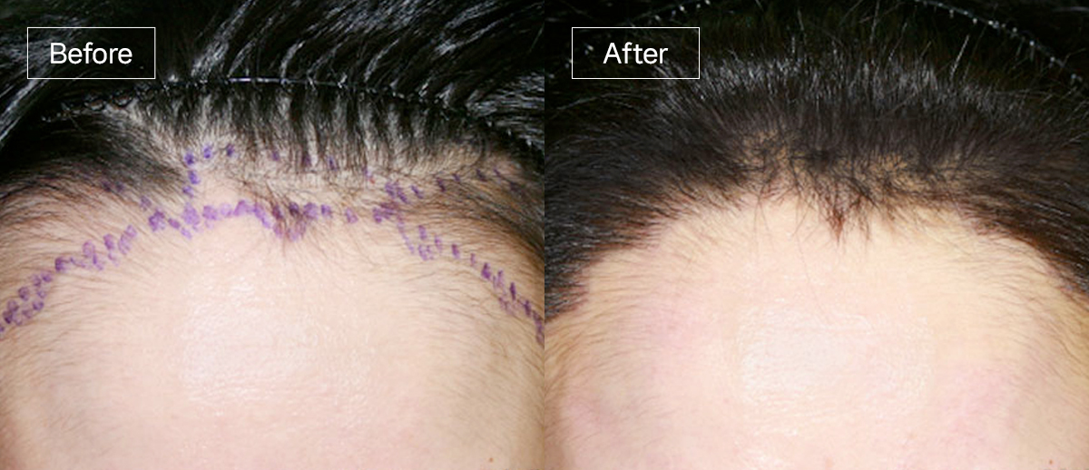 /filedata/md_board/20260102162020_rqCFJU0n_sub3_slide2.jpg 전후사진