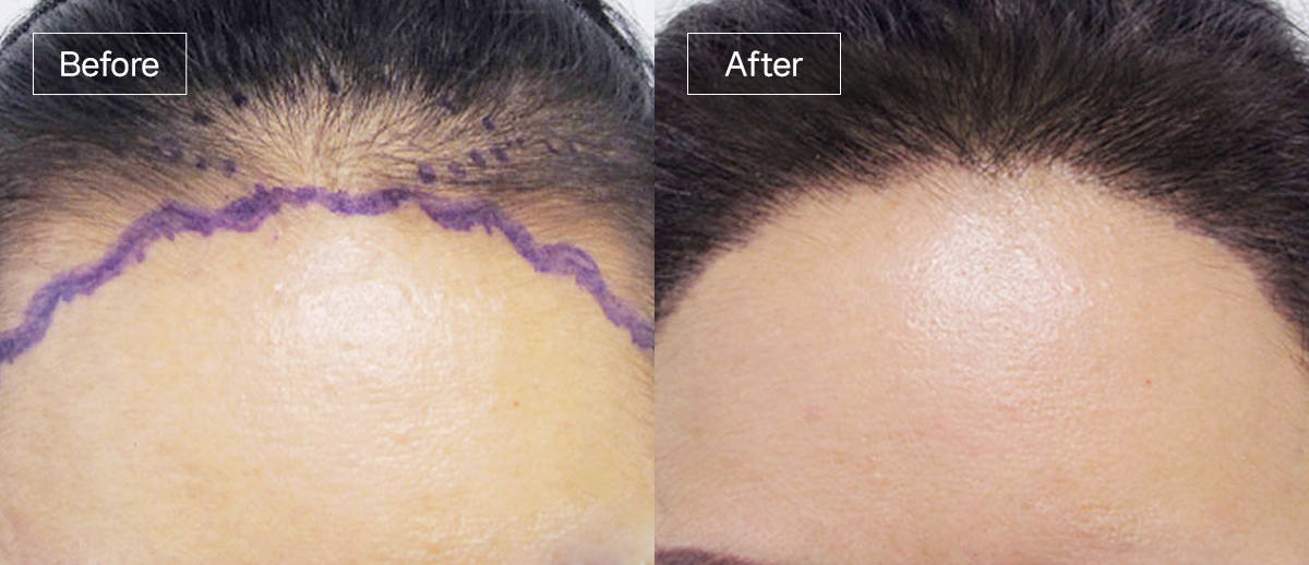 /filedata/md_board/20260102162041_41uCT0eX_sub3_slide5.jpg 전후사진