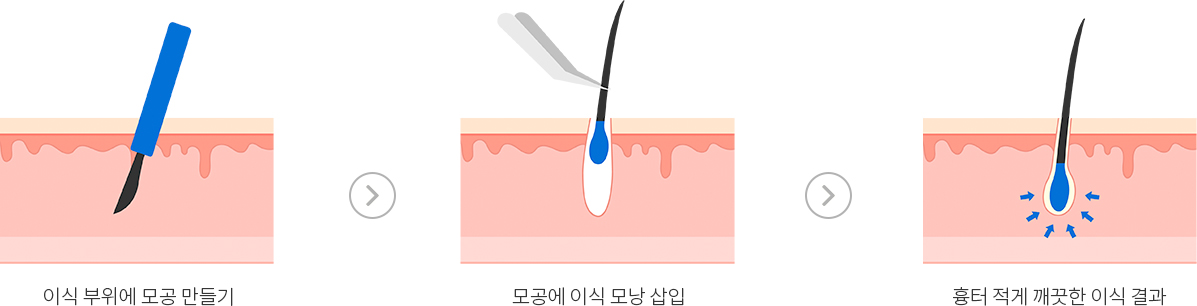 모낭1